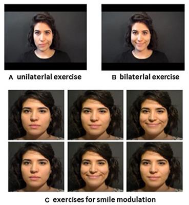 Post-surgery Rehabilitative Intervention Based on Imitation Therapy and Mouth-Hand Motor Synergies Provides Better Outcomes in Smile Production in Children and Adults With Long Term Facial Paralysis